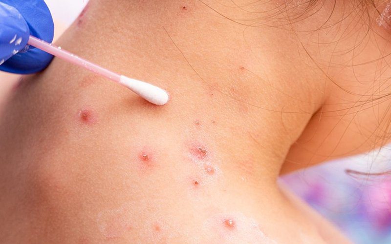 OMS anticipa que aparecerán más casos de la viruela del&nbsp;mono