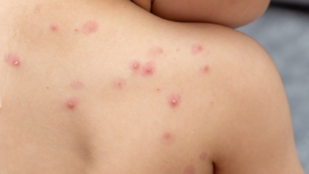 Detectan caso sospechoso de viruela del mono en&nbsp;Venezuela