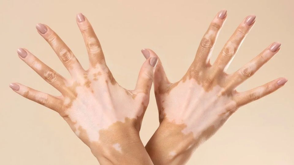 Unión Europea aprobó un tratamiento para el&nbsp;vitiligo