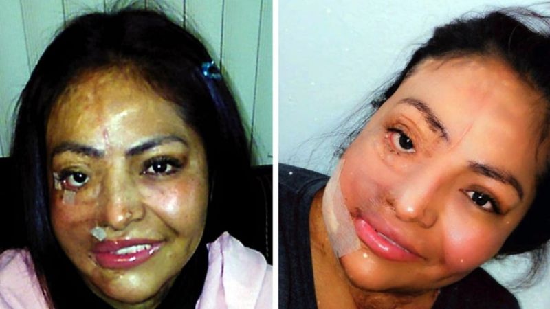 Cuando condenaron a mi expareja, lo primero que recordé fue el ardor terrible de cuando me arrojó el ácido y sentía que se comía mi&nbsp;piel»