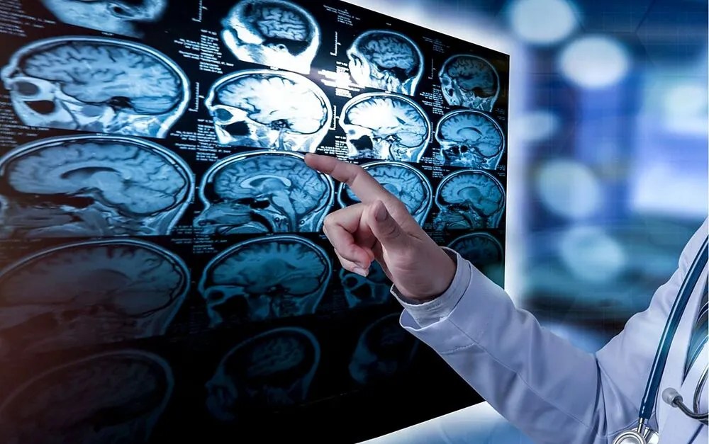 Descubren un segundo caso de una persona inmune al&nbsp;alzhéimer