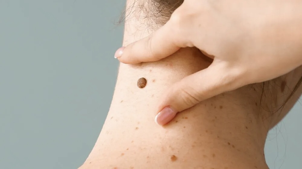 El cáncer de piel es uno de los más comunes a nivel&nbsp;mundial