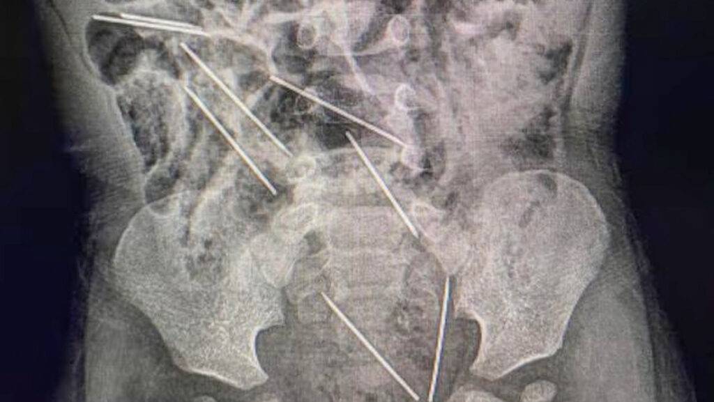 Niño se traga ocho agujas hipodérmicas: así es su&nbsp;estado
