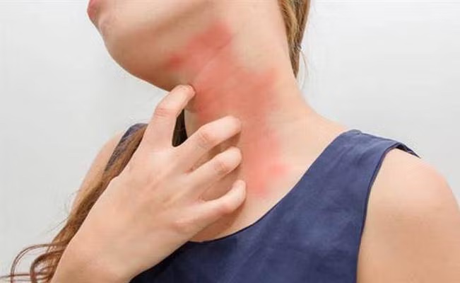 Anafilaxia, la reacción alérgica más grave que podrías&nbsp;tener