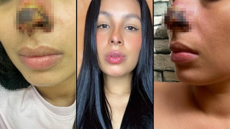 Una mujer casi perdió su nariz tras inyectarse ácido&nbsp;hialurónico