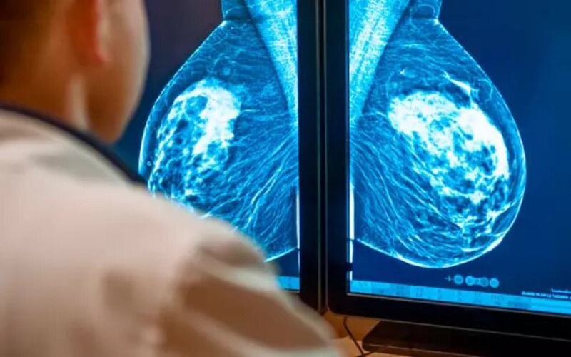 Reciente hallazgo podrían ayudar a evitar la metástasis en el cáncer de&nbsp;mama