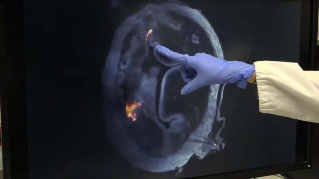 Novedosa terapia logra reducir 90% el tamaño de los tumores de&nbsp;vejiga