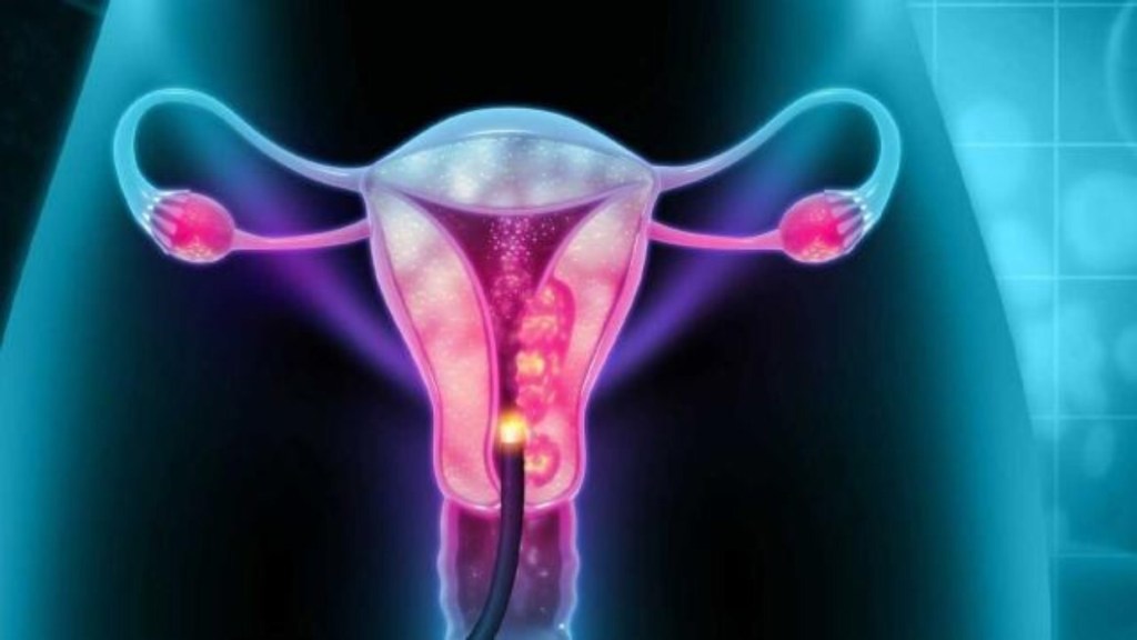 El cáncer de cuello uterino podría ser el primero en ser&nbsp;erradicado