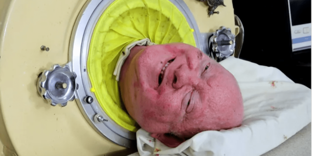 Murió Paul Alexander, el hombre que vivió más de 70 años con un pulmón de&nbsp;acero