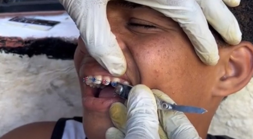 Alertan sobre los graves riesgos de la odontología&nbsp;callejera