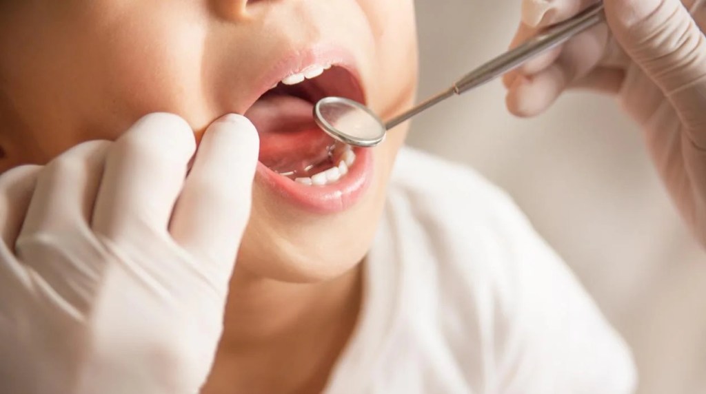Investigadores desarrollan tratamiento que logran eliminar caries sin&nbsp;anestesia