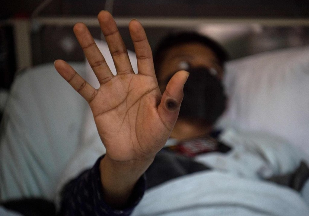 Reportan en Suecia el primer caso en Europa de variante de la viruela del&nbsp;mono&nbsp;