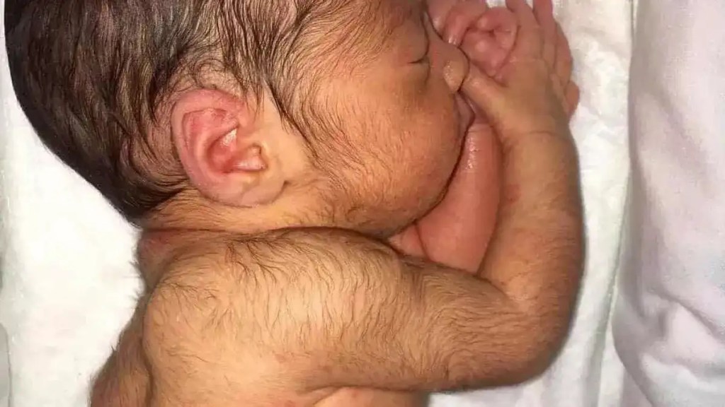 Bebés desarrollan síndrome del hombre lobo tras sus padres usar&nbsp;minoxidil