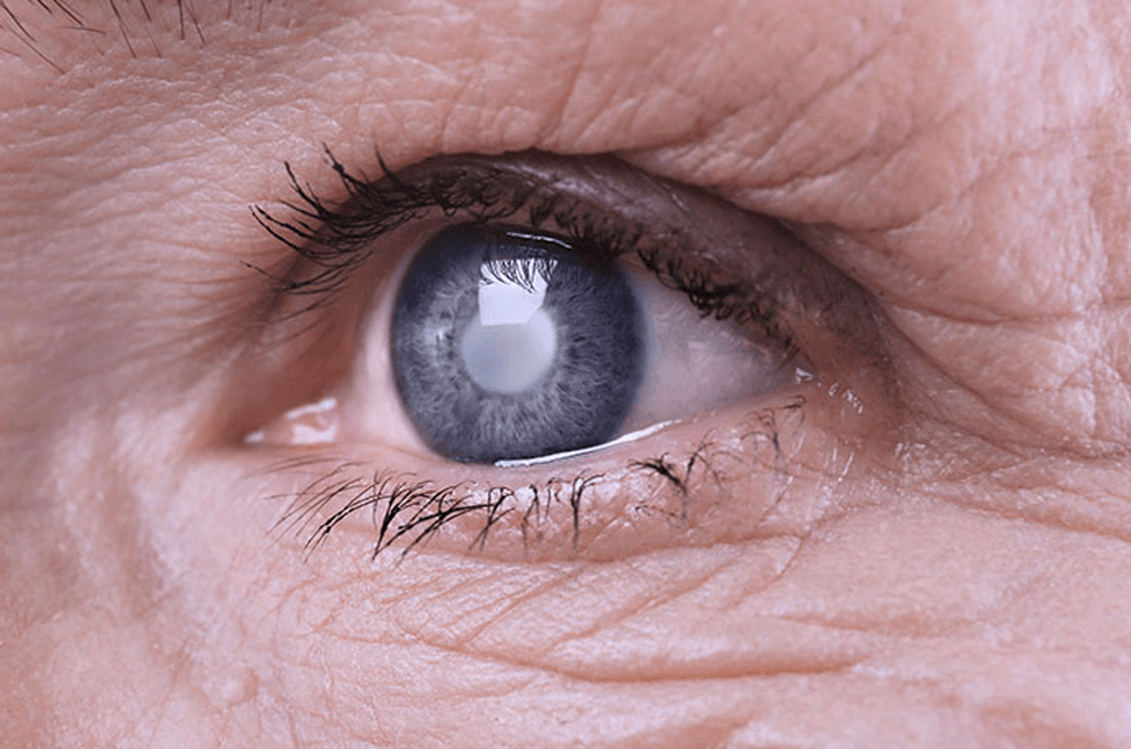 Estudio revela inesperada relación entre el colesterol y el&nbsp;glaucoma