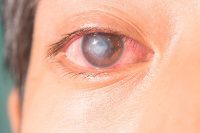 Innovador tratamiento con células madre devuelve la visión a pacientes con daño&nbsp;corneal