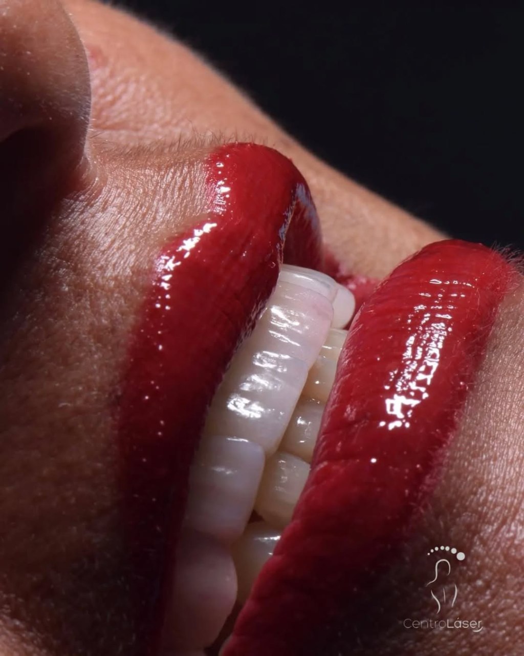 Impresionante Rehabilitación Bucal con Implantes de Última Generación realizó Centro Láser en&nbsp;Lechería