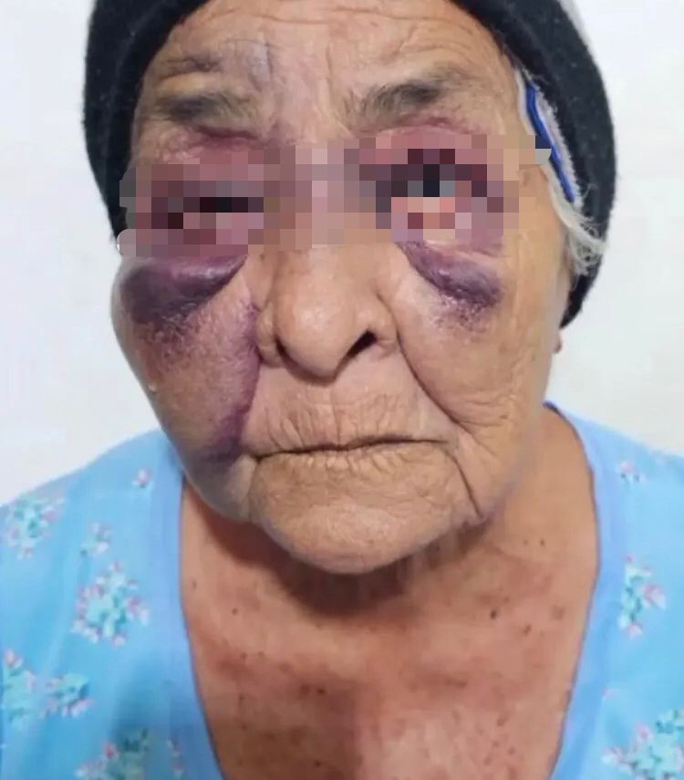 Mujer de 85 años fue brutalmente agredida por su hijo en el&nbsp;Zulia&nbsp;