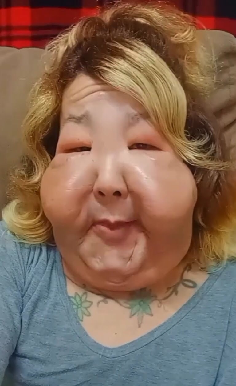 Influencer brasileña se deformó el rostro tras realizarse un tratamiento estético clandestino&nbsp;