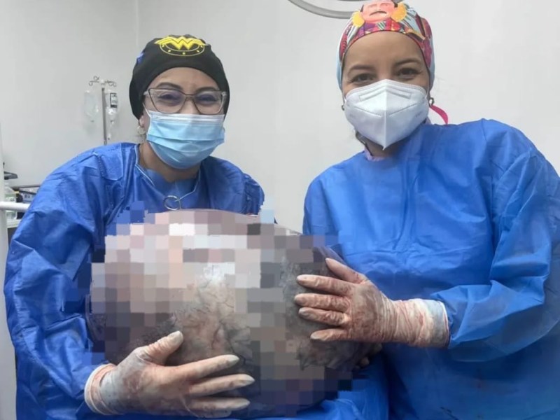 Equipo médico del Razetti extrajo tumor de 25 kilos a mujer de 52 años del municipio&nbsp;Sotillo